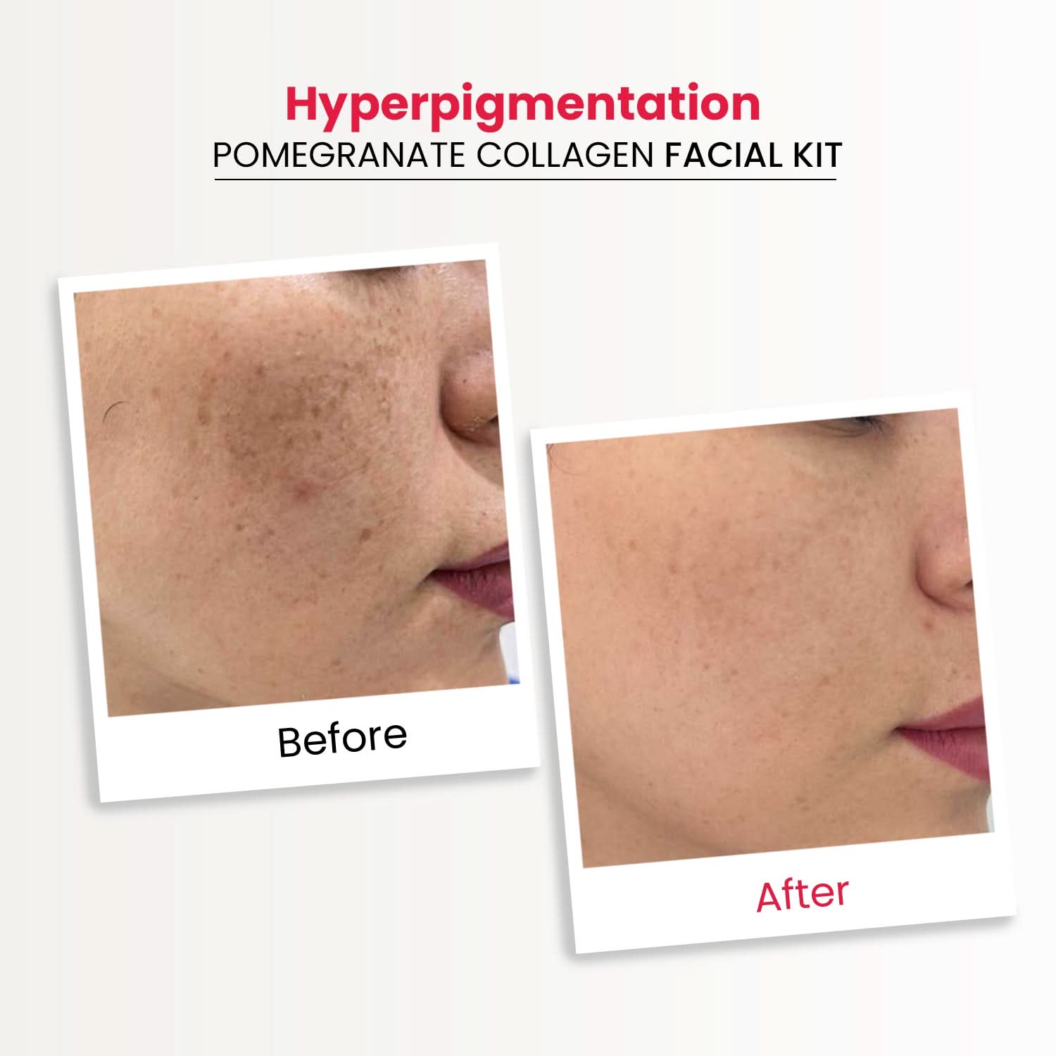 Hyperpigmentation Facial Kits Combo-Pack of 2