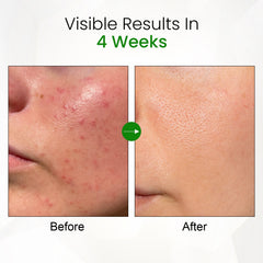 Innate Acne Reset System | Cleanser + Corrector | Oily & Acne-Prone Skin